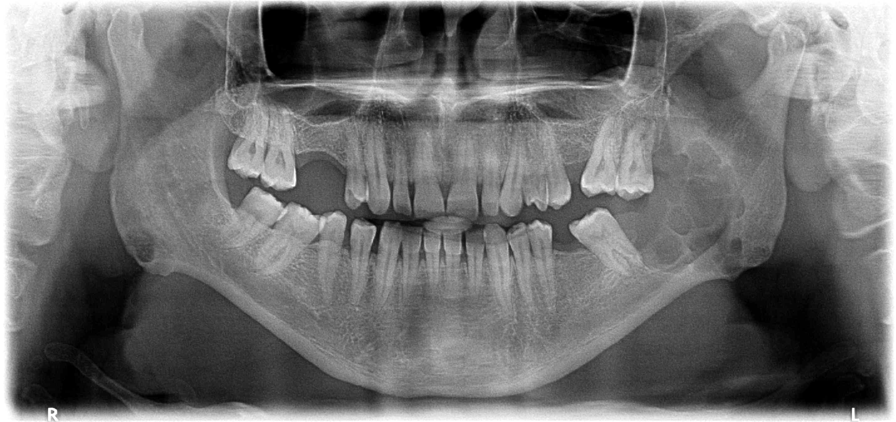 Radiografie panoramică pentru ilustrarea evaluării unei formațiuni din sfera oro-maxilo-facială