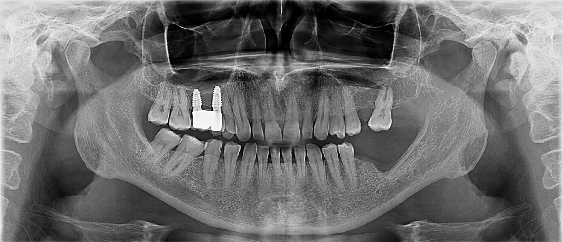 Radiografie panoramică anonimizată prezentată ca rezultat după depistare și terapie